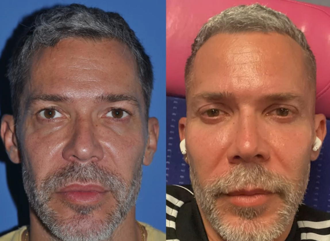 👨‍⚕️Minimum Access Blepharoplasty+Canthal Support+Lipofilling